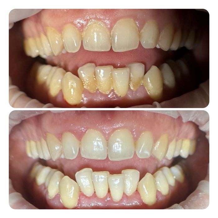 Професійна чистка зубів