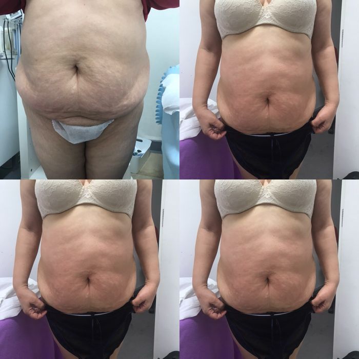 Pressoterapia drenagem linfantica mecanica