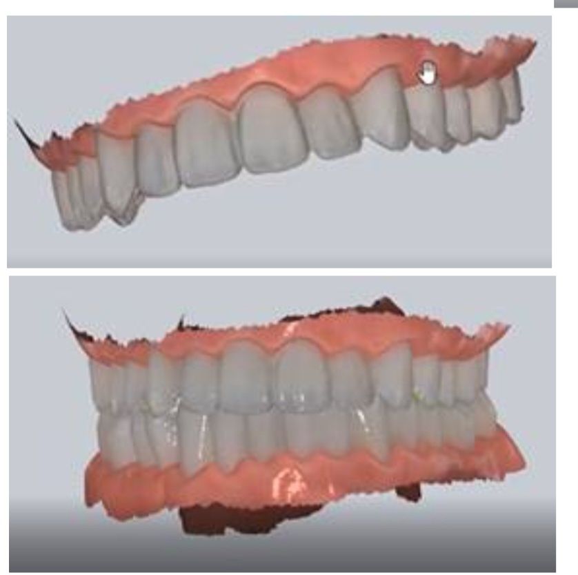 Scanner Intraoral