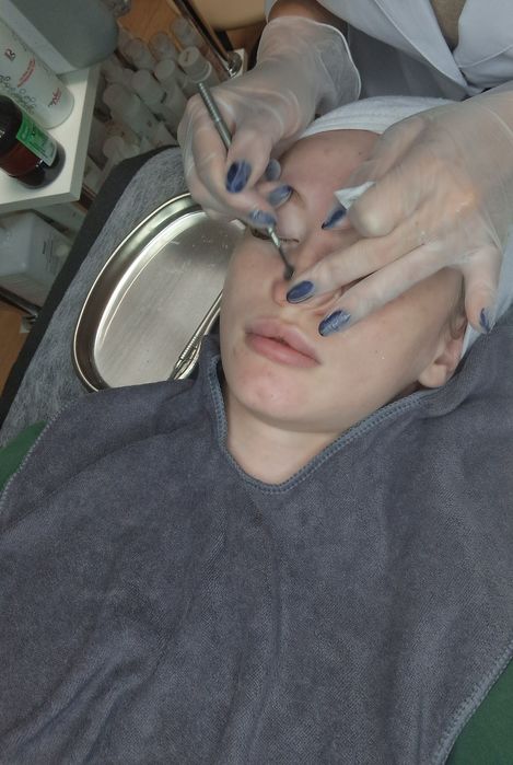 Естетична косметологія. Мікронідлінг