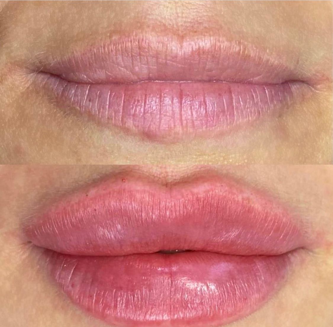 Botox/fullFace/контурная пластика/ губы