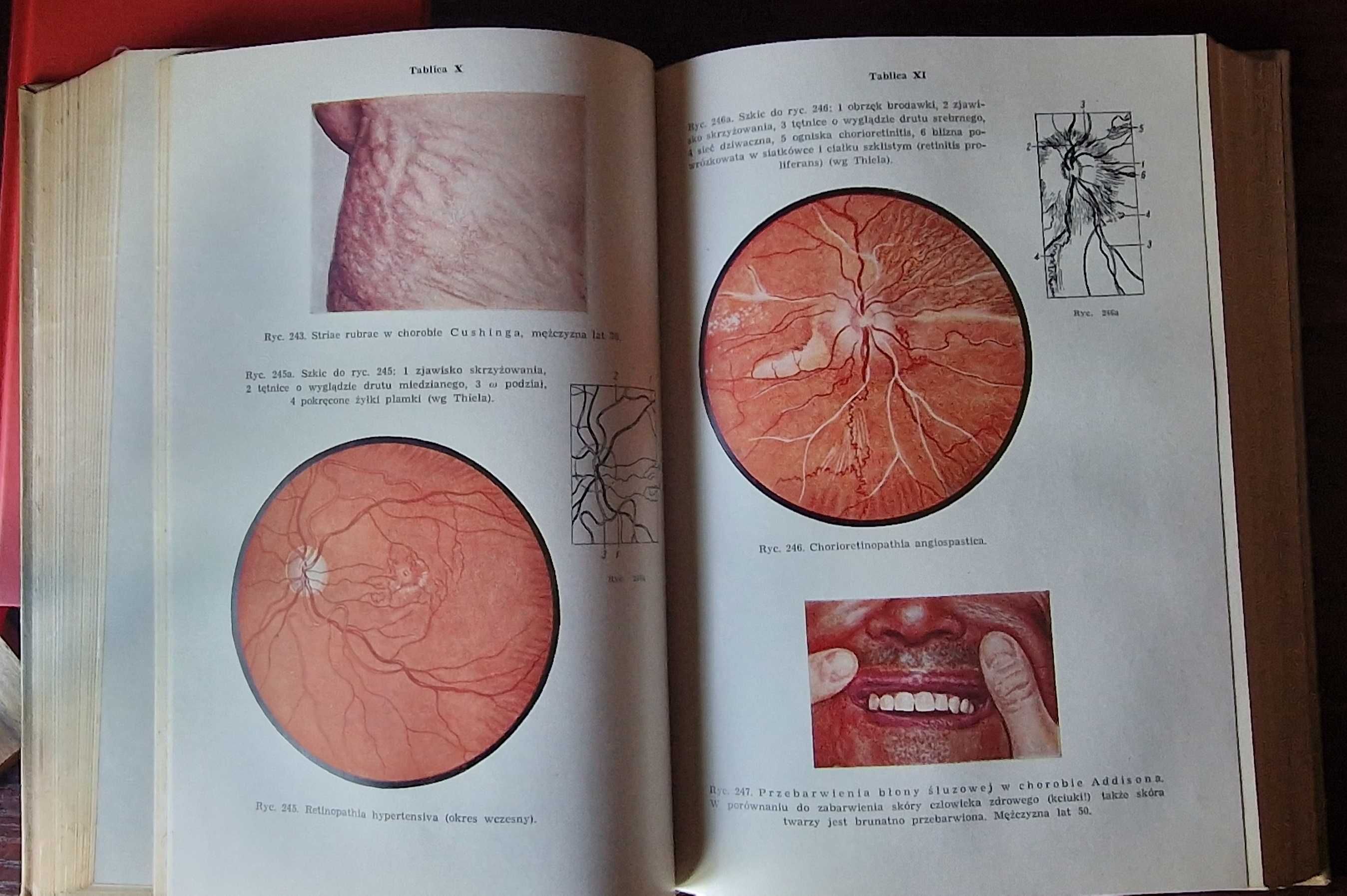 Diagnostyka różnicowa w chorobach wewnętrznych Hegglin 1960 książka