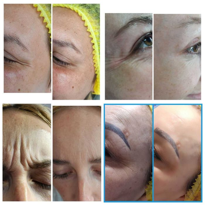 Опытный косметолог | Чистки, пилинги, инъекции