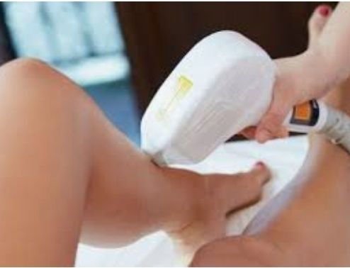 Depilação a laser diodo