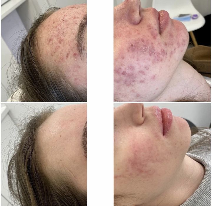 Лечение акне, врач дерматолог , врач косметолог.