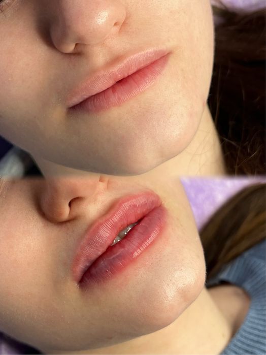 Акція. Контурна пластика губ. Запоріжжя