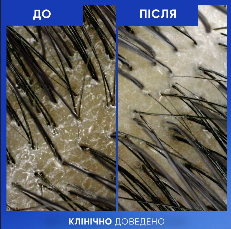 Шампунь проти лупи Head & Shoulders Classic 400мл (хеденшолдерс)