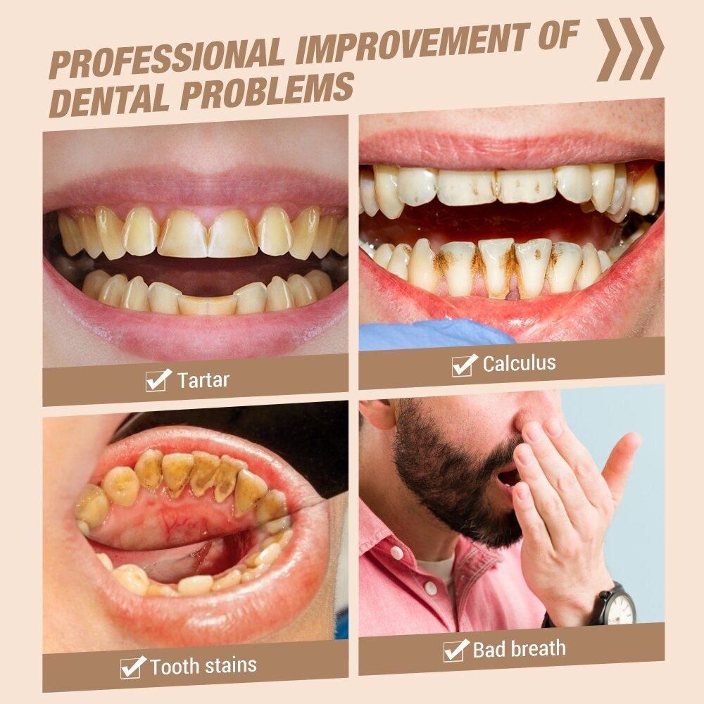 Прилад для видалення зубних каменів скалер.скайлер стоматологічний