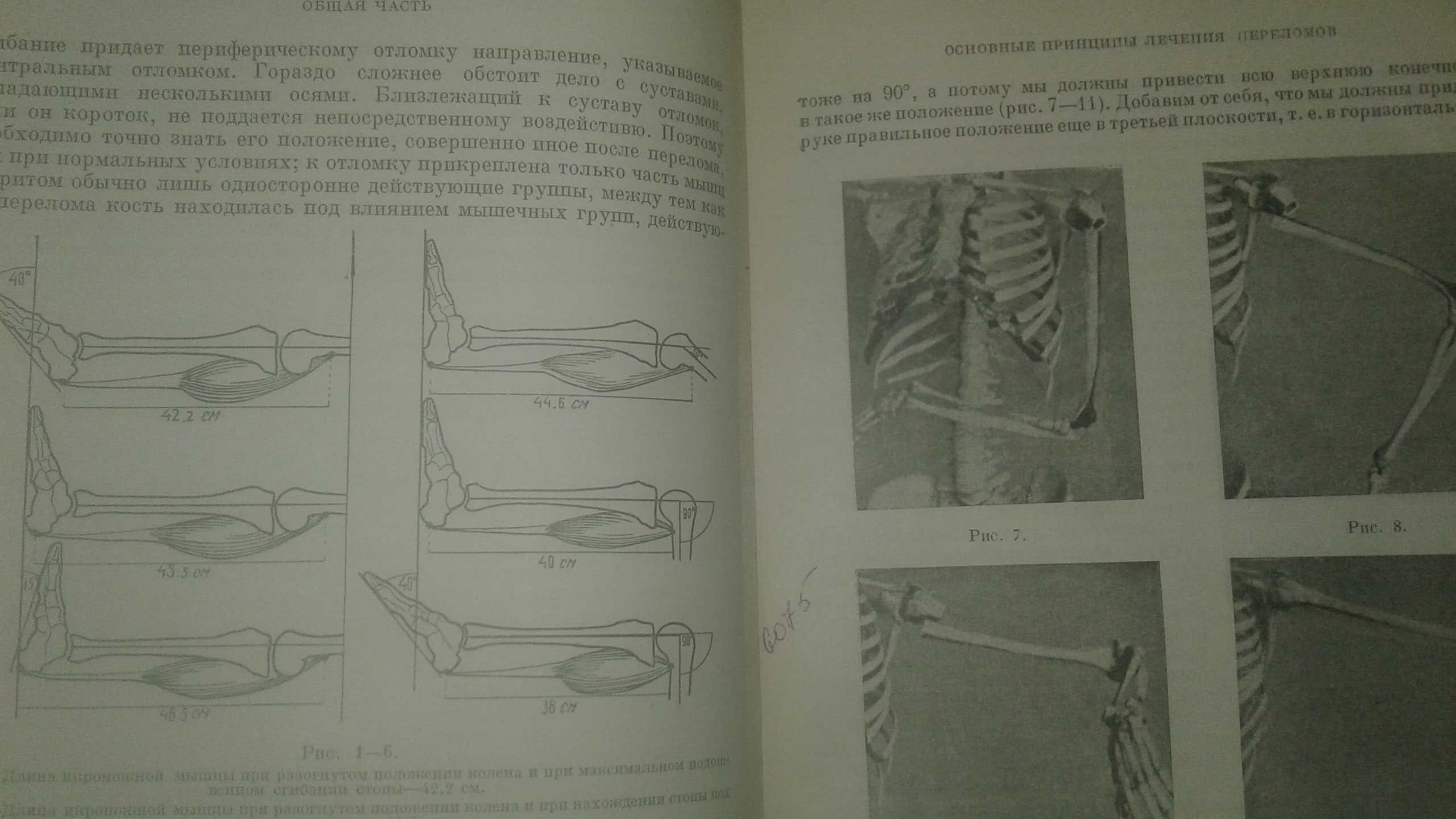 Лечение переломов костей 1937 год Леон Белер антикварная книга