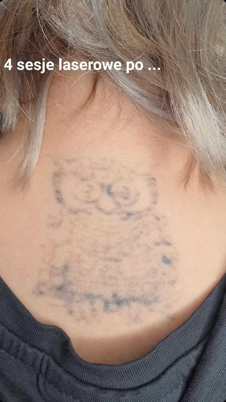 Pro laser NS+ do usuwania makijażu permanentnego tatuażu przebarwień