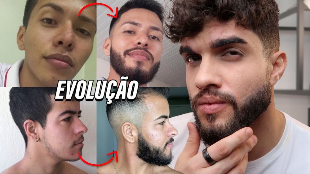 Minoxidil! Fim da calvície ! Crescimento de barba