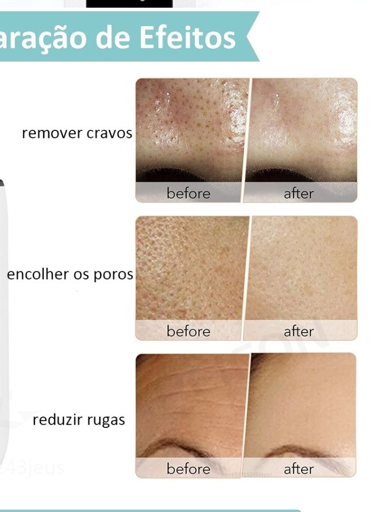 Limpador facial ultrasonico,remove, acne ,poros,esfoliante, rugas.