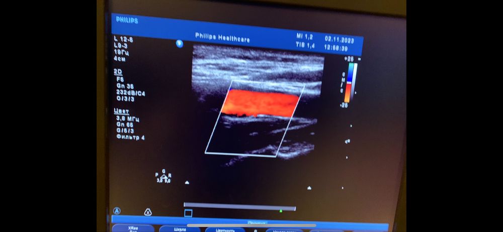 датчик узд узи philips лінійний l 9-3 до hd 11xe ,iu 22 та ie 33.