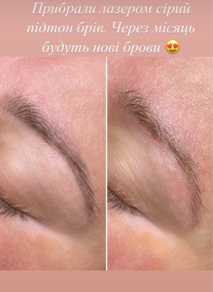 Лазерне видалення брів безболісно лазер удаление татуажа