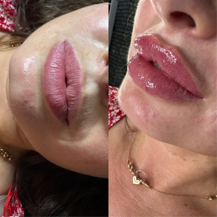 Косметолог/Кривий Ріг/ Збільшення губ/увеличение губ.