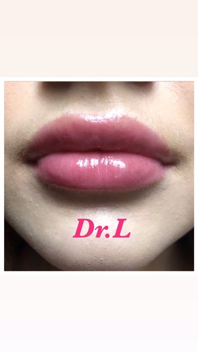 Збільшення губ, видалення папілом, родимок, бородавок