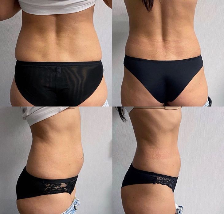 Ботокс, мезонити, увеличение губ,ягодиц