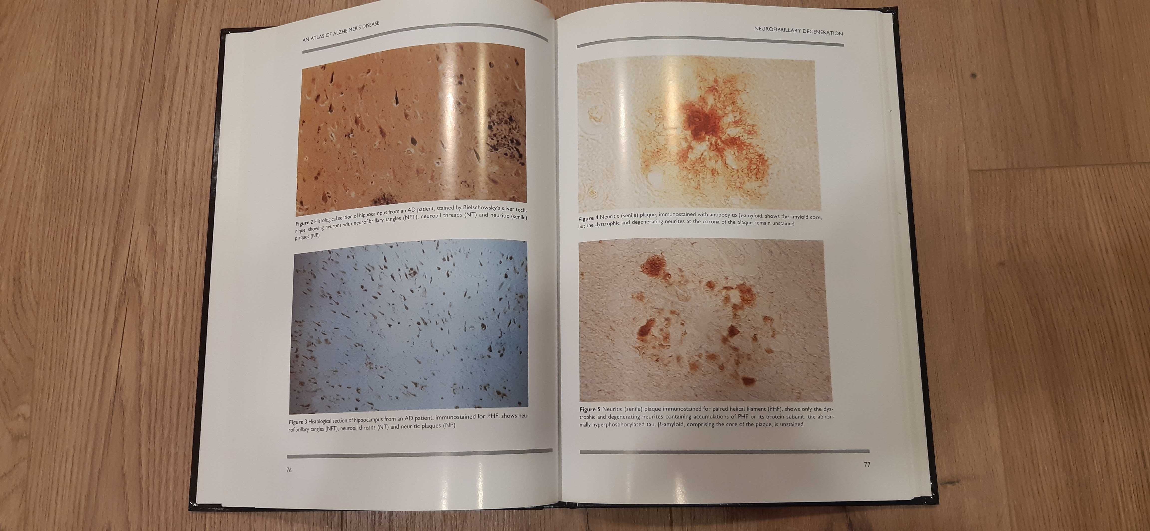 Livro Atlas of Alzheimer's disease