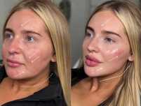 Usta, stymulatory tkankowe, wolumetria, botox, btx NATURALNE EFEKTY!!