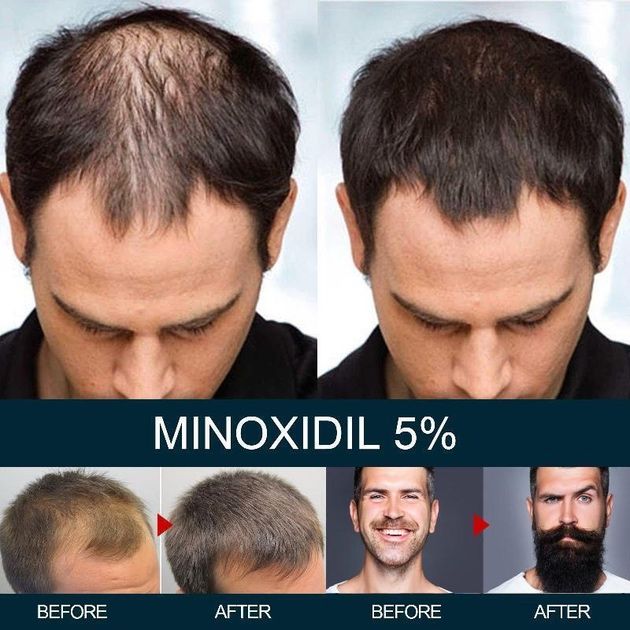NEW Minox 5% Засіб для росту волосся та бороди 60ml