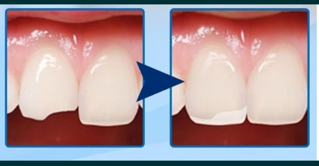 Полимерный Гель для встановлення зубов 10г и 20г