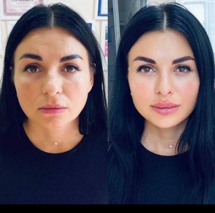 Лікар косметолог. БОТОКС . Ін'єкції краси.