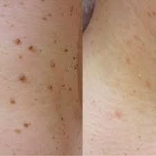 Косметолог-уход-массаж, удаление папиллом, бородавок, пигментных пятен