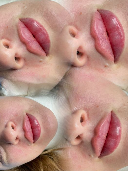 Увеличение губ, 1500 грн, топ техника!