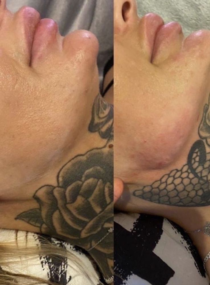 Powiększanie ust RUSSIAN LIPS 1ml 600zl, botox,dolina łez, model brody