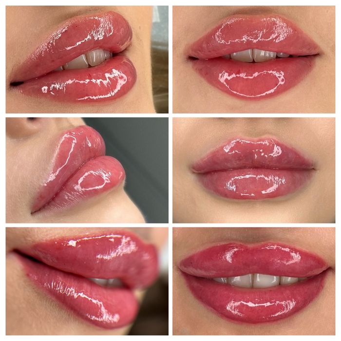 Powiekszanie ust, powiększanie, modelowanie ust