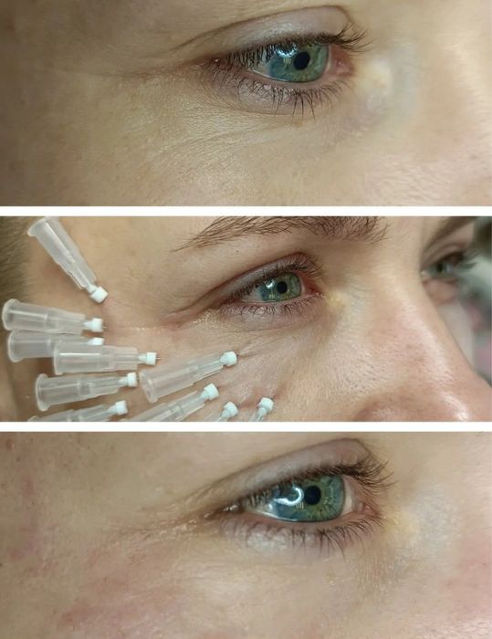 Metamorfoza bez skalpela, lifting,odmładzanie na 1 wizycie WRO centru