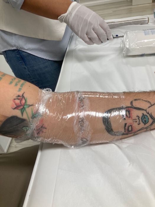 Depilacao a laser, remocao de tatuagem, peeling