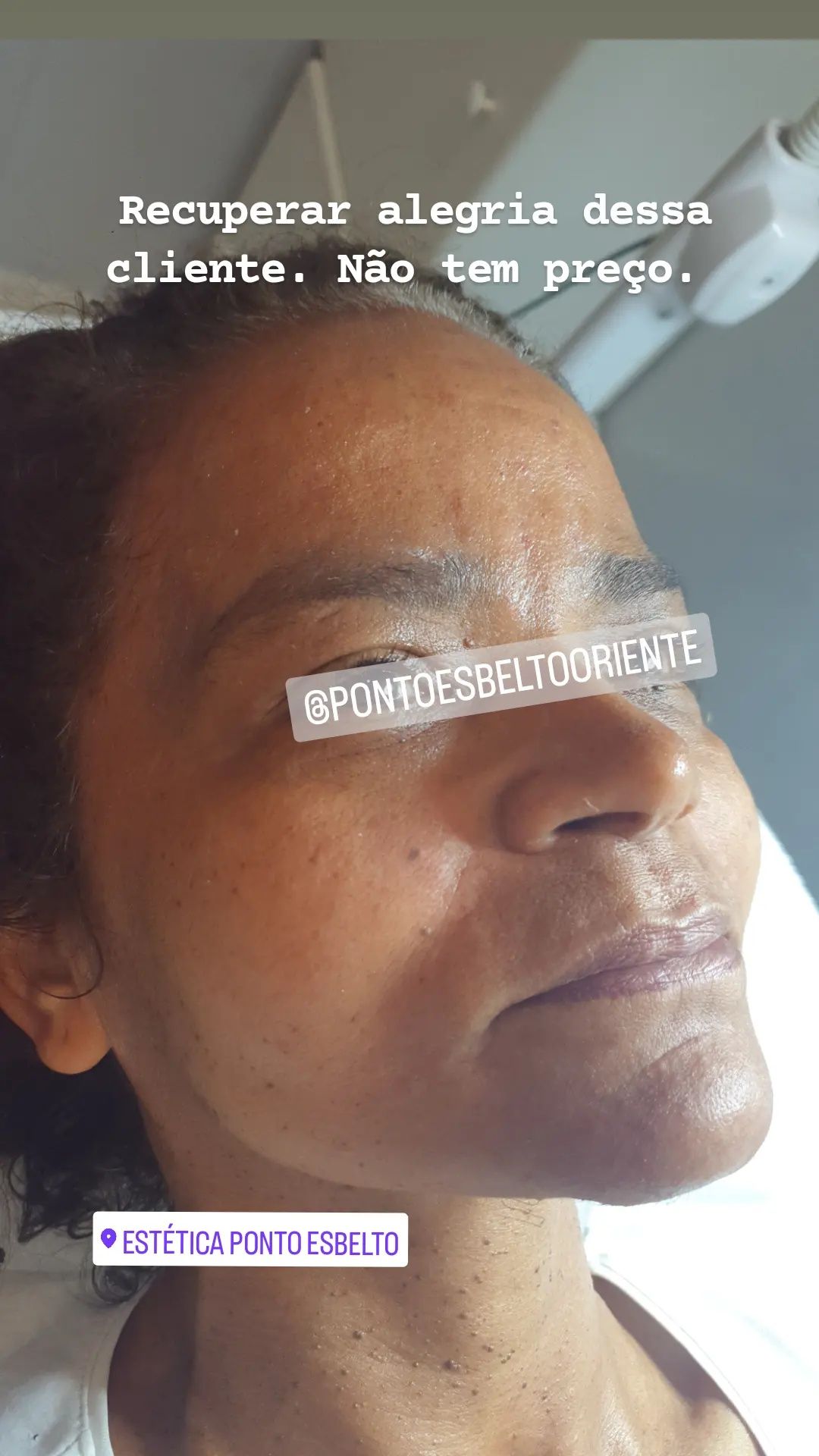 Preenchimento labial e harmonização facial e Lipo enzimática