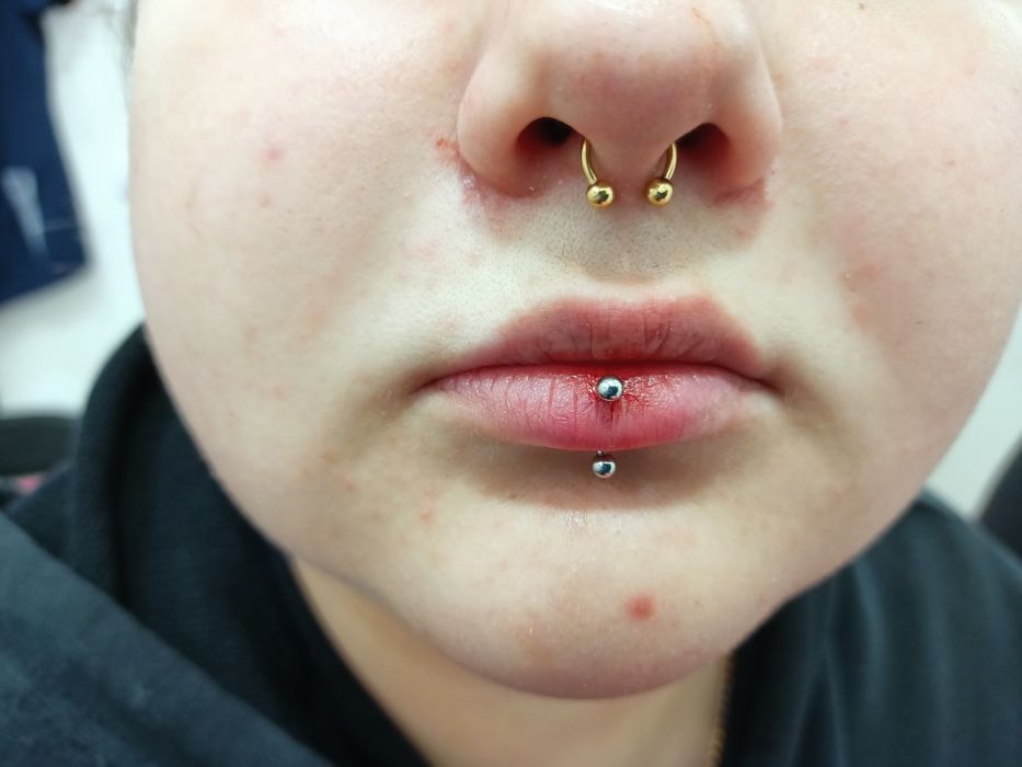 Косметолог, Біоревіталізація, Ботокс, Контурна пластика , мезотерапія.