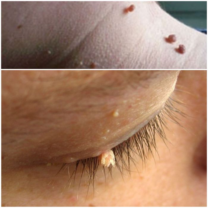 Косметолог-уход-массаж, удаление папиллом, бородавок, пигментных пятен