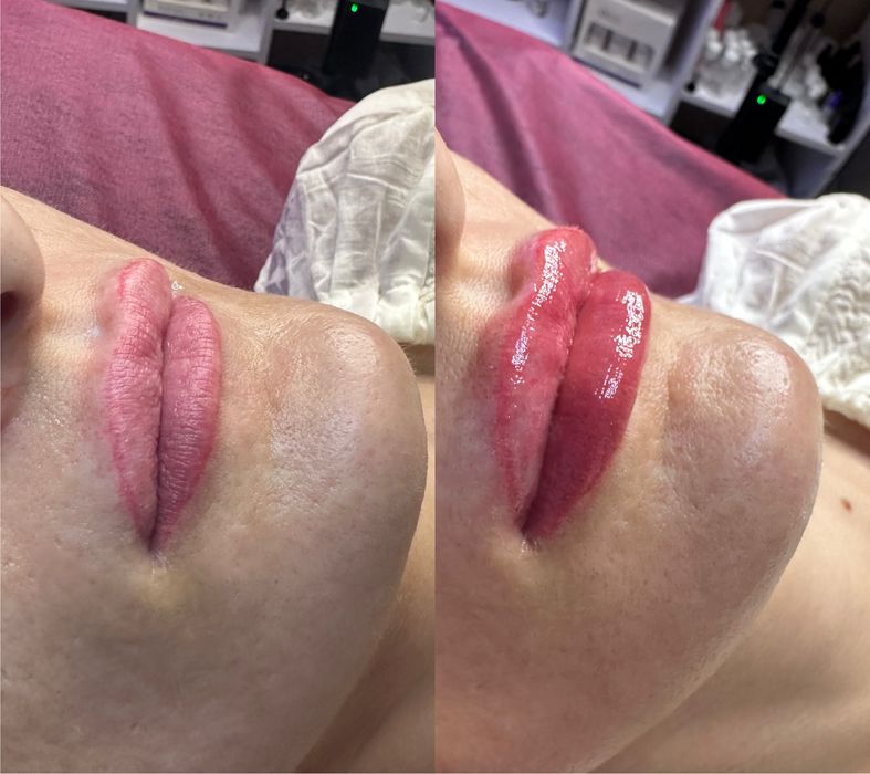 Косметолог Харьков.Ботокс 800 грн /зона