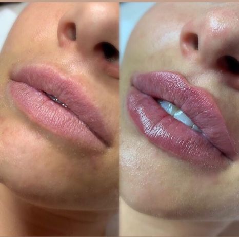 Контурная пластика губ, подбородка, углы Джоли, увеличение губ