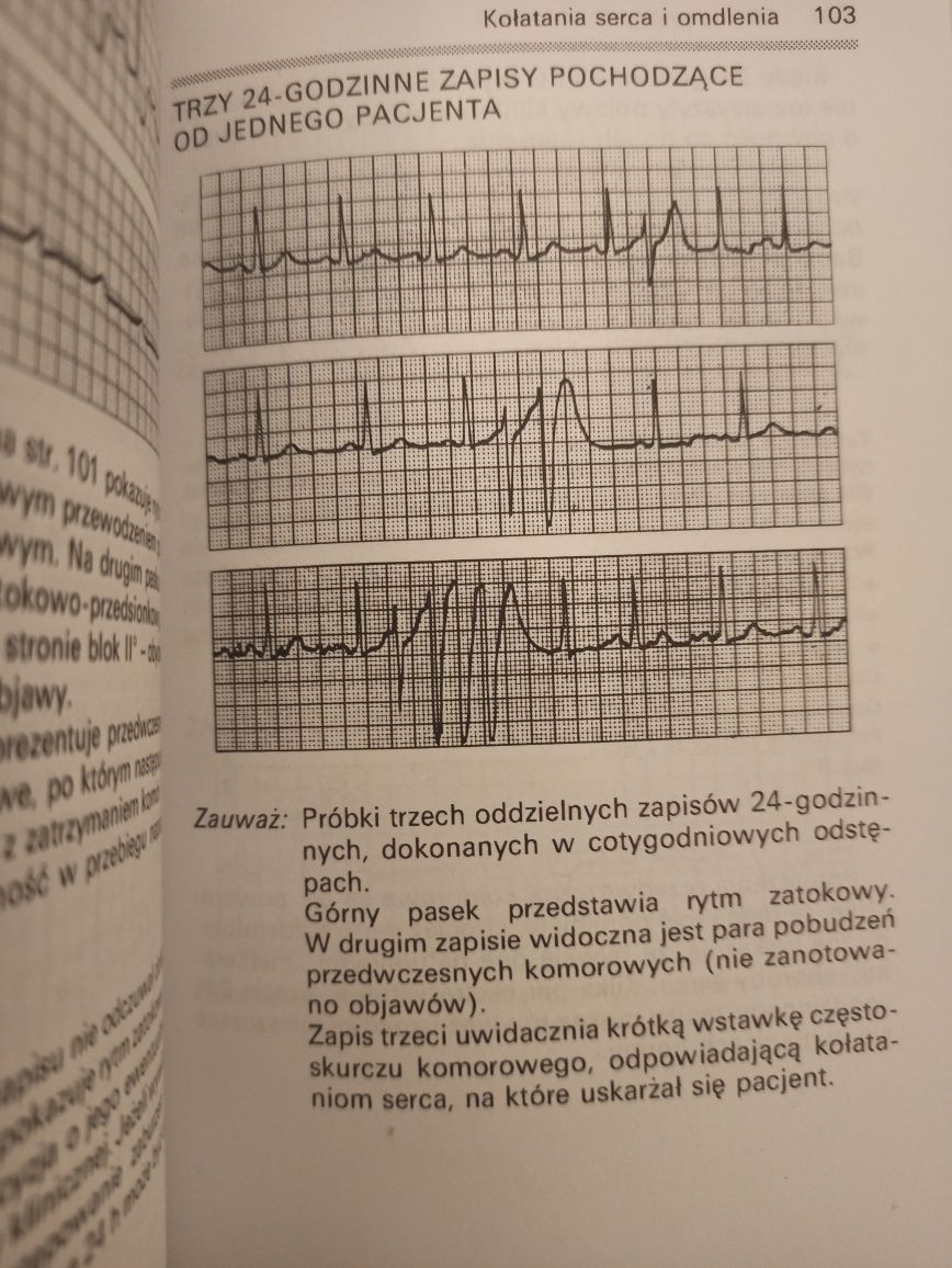 Ekg w praktyce, pzwl