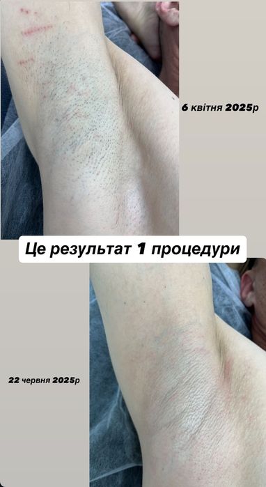 Чоловіча депіляція,шугаринг,віск,електроепіляція,лазерна епіляція Київ