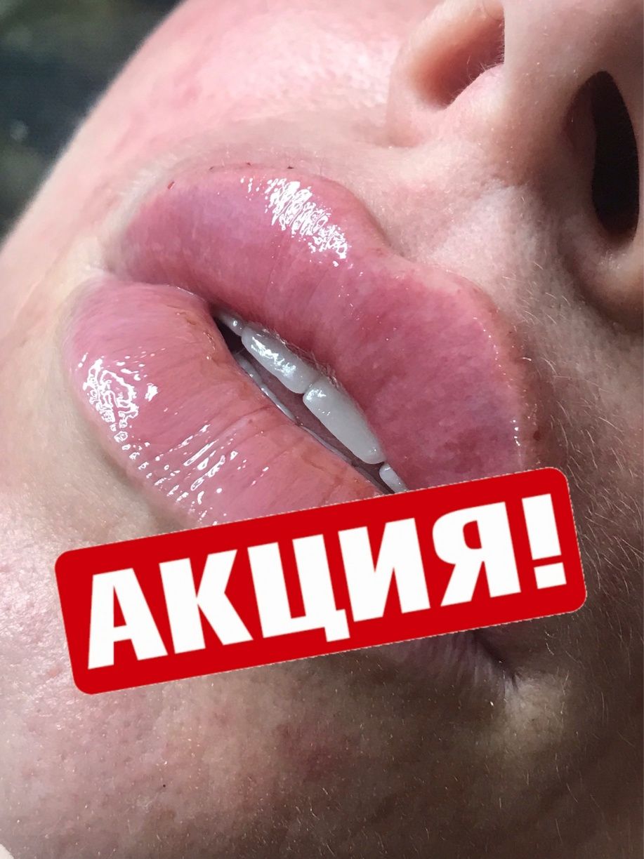 Збільшення губ, ботокс, біоревіталізація