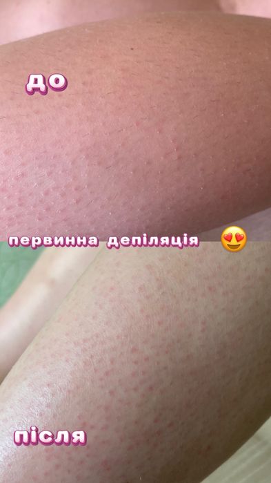 Шугаринг, сахарная депиляция 5 Заречный