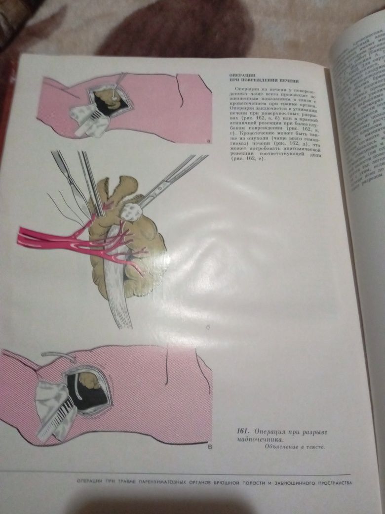 Атлас операций у новорожденных. Баширов, Дорошевский, Немилова. 1984 г