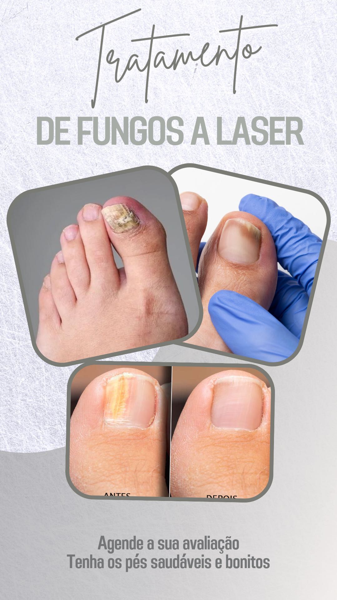 Alugo Máquina laser antifúngico, micoses e derrames