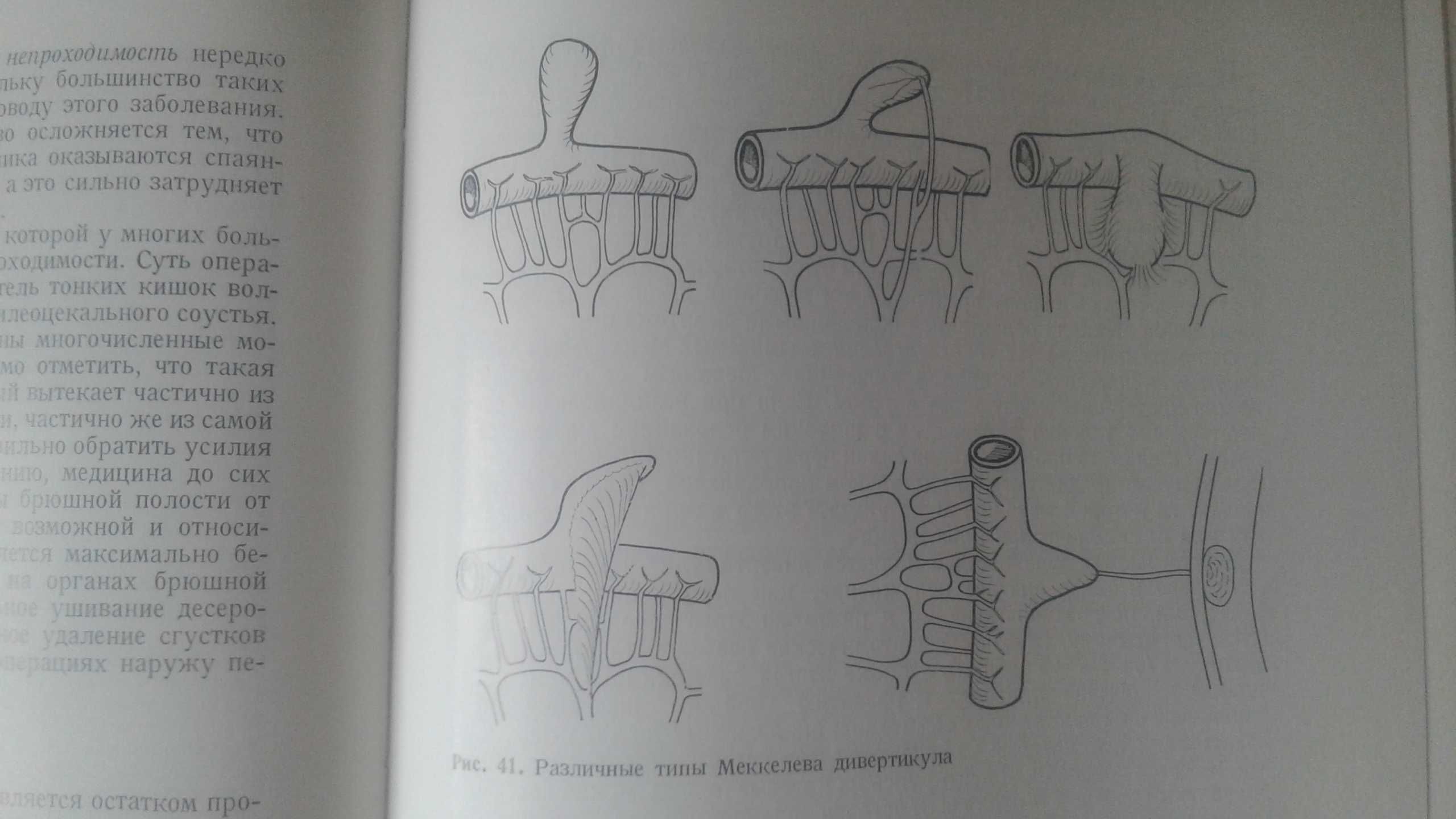 Хирургия кишечника