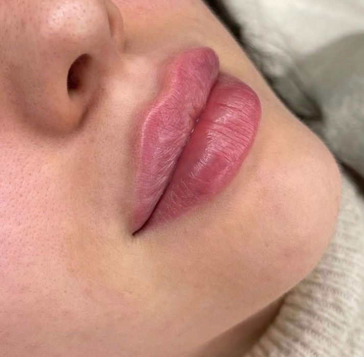 Ботокс, мезонити, увеличение губ,ягодиц