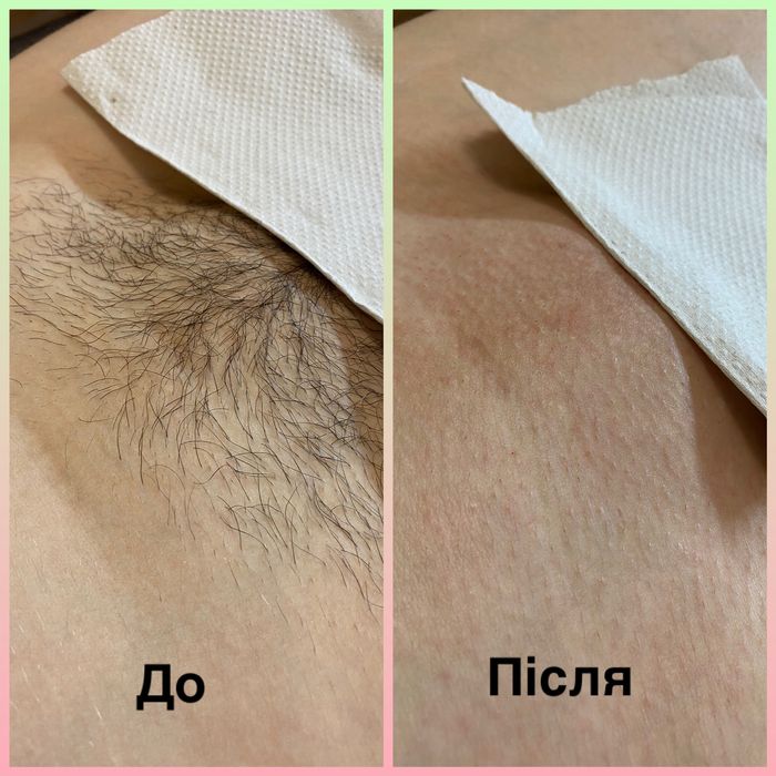 Шугаринг,воскова депіляція.