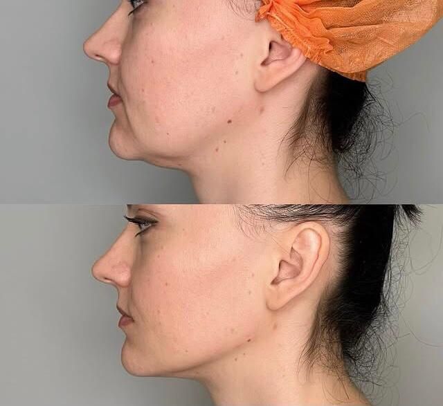 Косметолог- Дерматолог.Ботокс.Контурная пластика. Чистка лица. Массаж