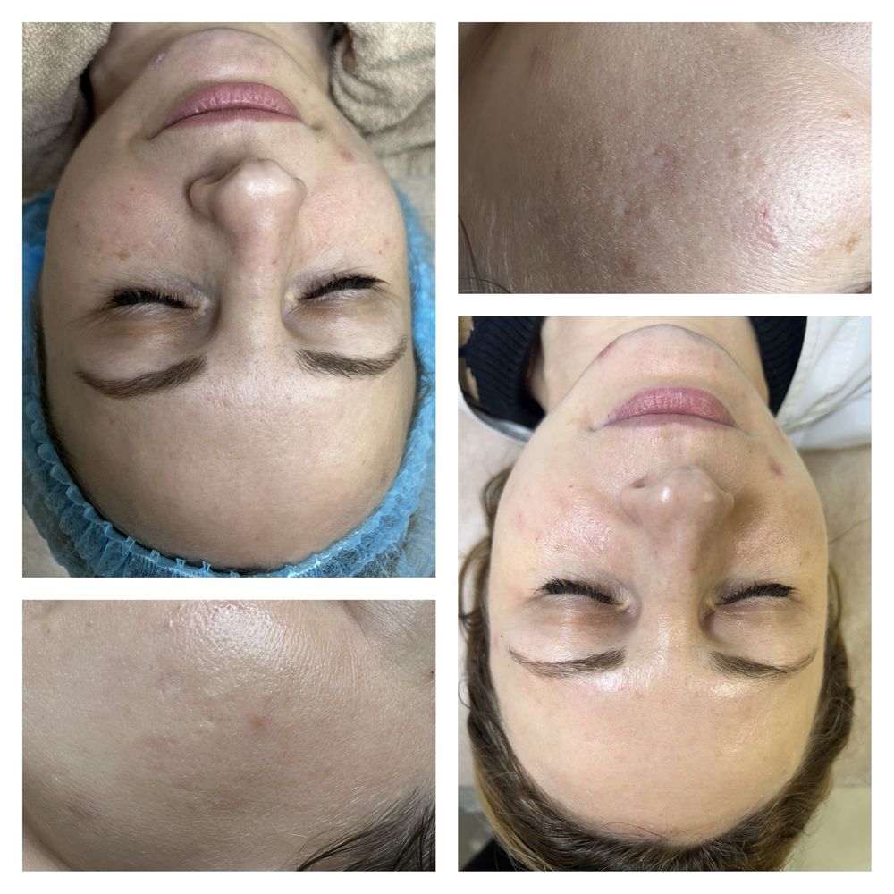 Косметолог Одеса, чистка/масаж обличчя, пілінг, карбоксітерапія
