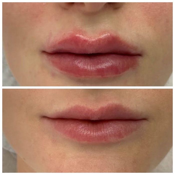 Ботокс| Збільшення губ