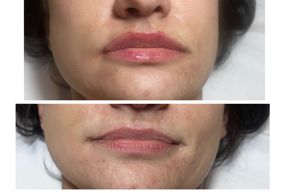 Oczyszczaie, zabiegi na twarz, modelowane ust kwasem hialuronowy